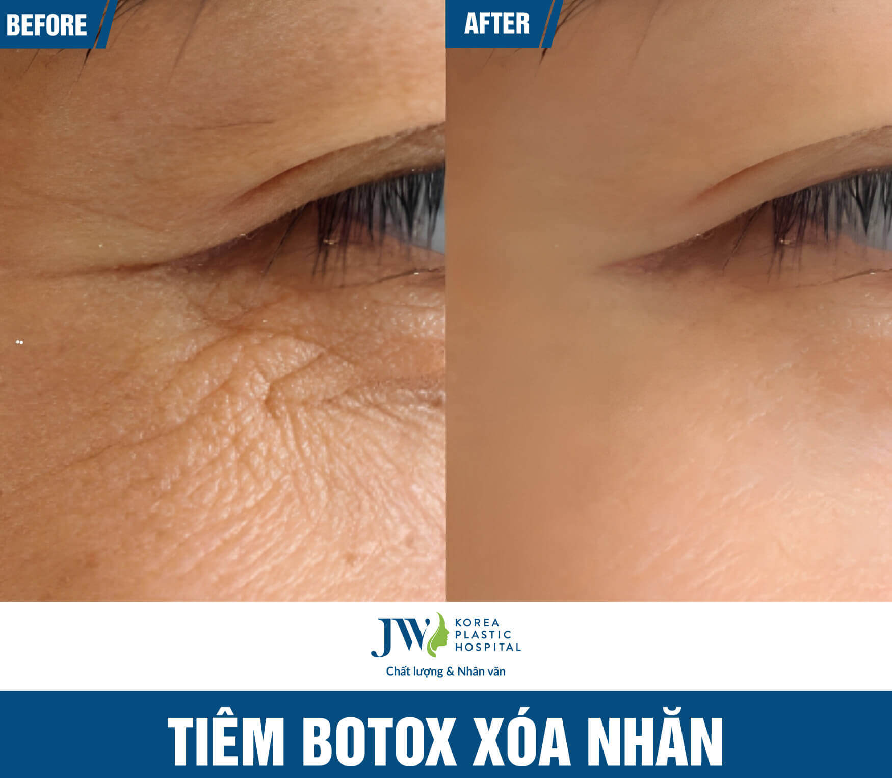 botox-xoa-nhan