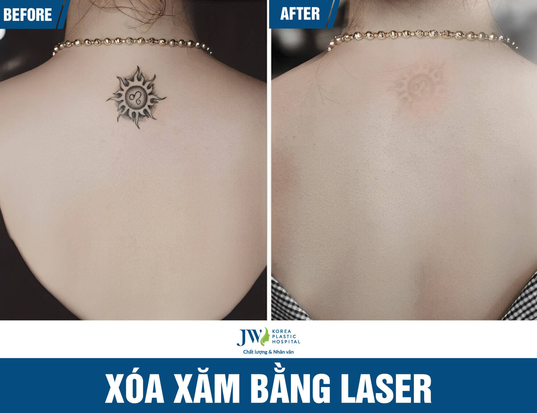 xoa xam bang laser