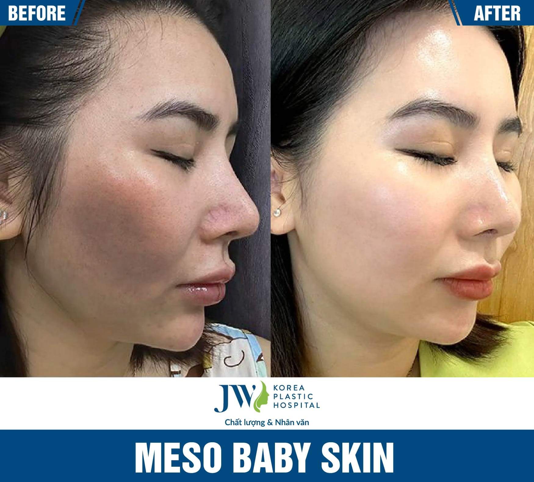 meso baby skin