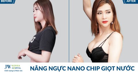Nâng ngực Nano chip 3D – Tôn tạo vòng 1 đầy đặn như ý