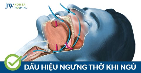 Hội chứng ngưng thở khi ngủ: Nguyên nhân xảy ra do đâu?