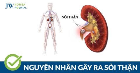 Sỏi thận, sỏi bàng quang: Nguyên nhân, dấu hiệu và cách điều trị