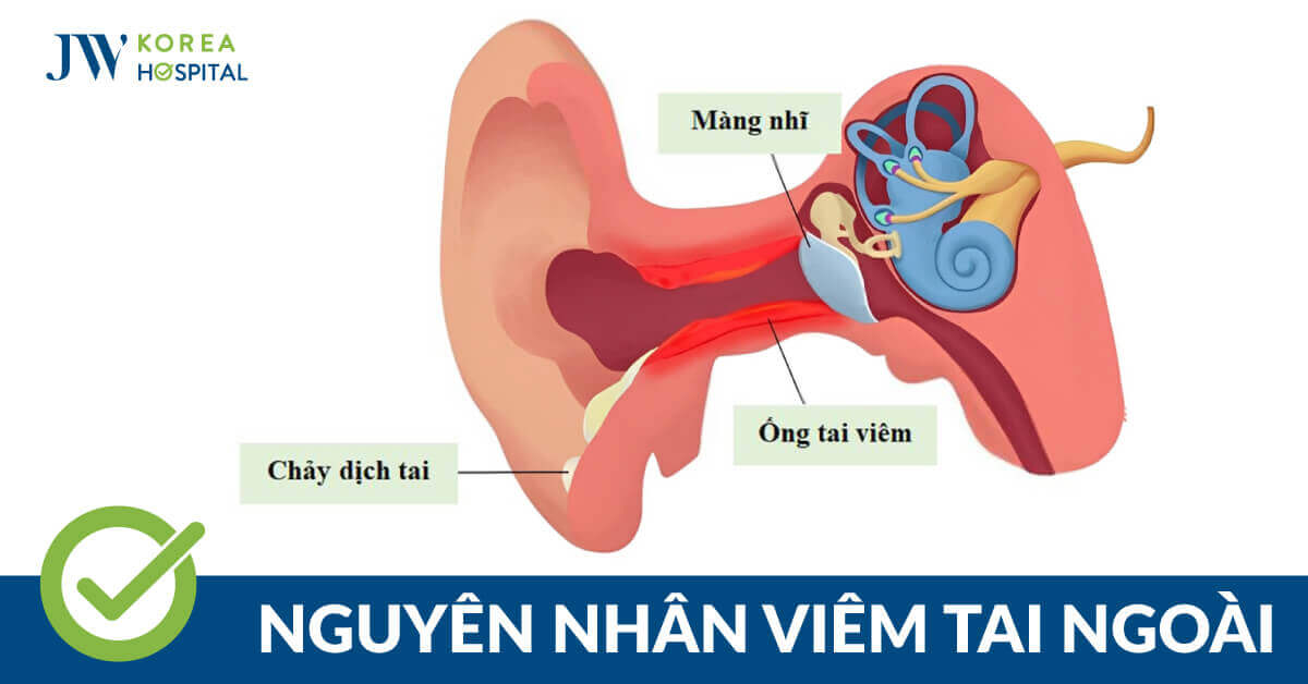 Viêm tai ngoài: Nguyên nhân, dấu hiệu, cách điều trị 