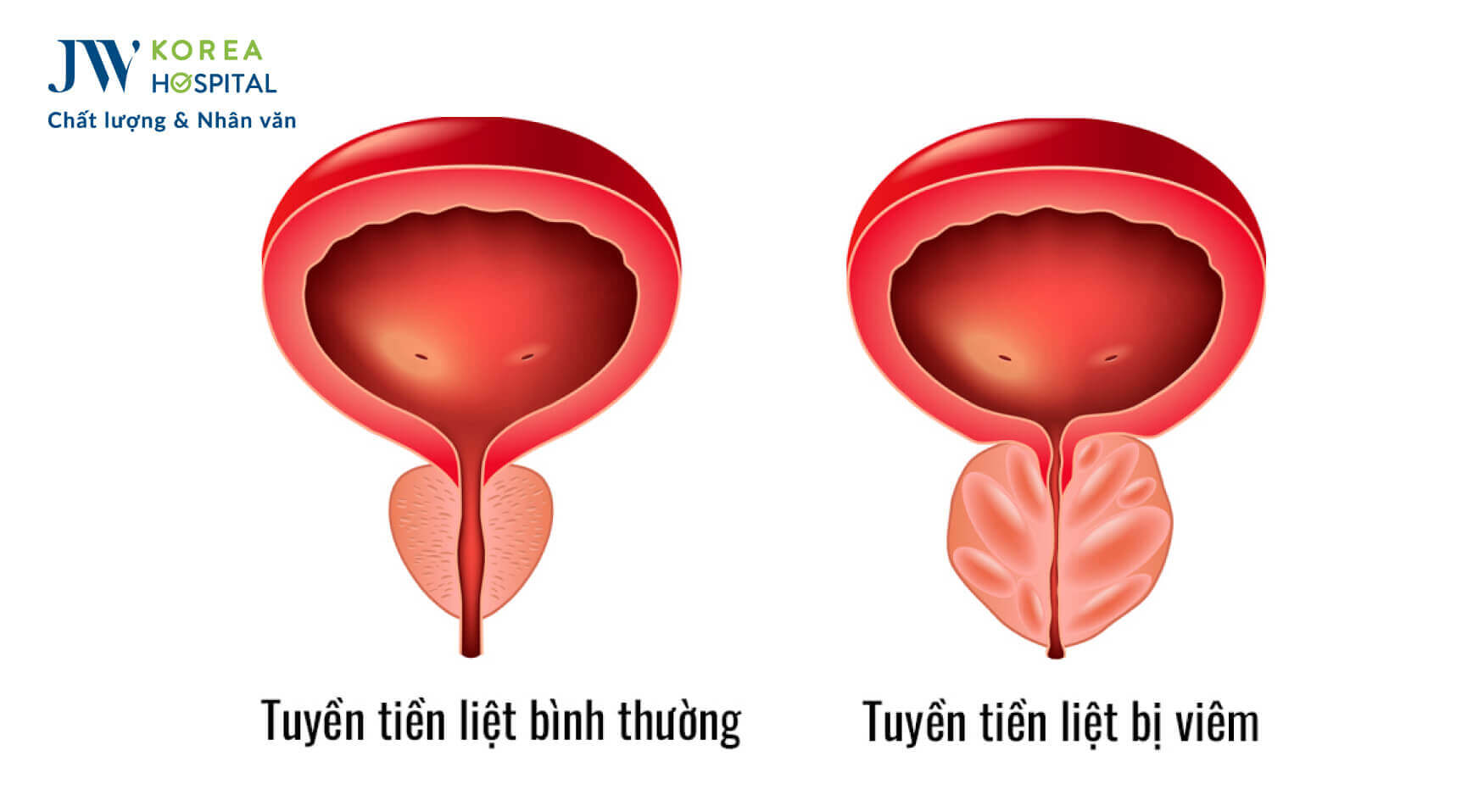 nguyen-nhan-gay-viem-tuyen-tiet-nieu