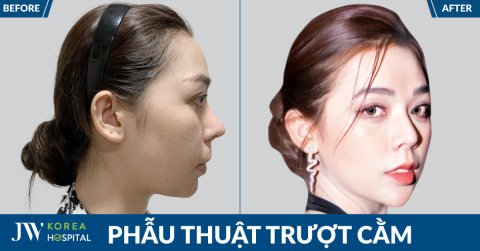 Hot Tiktoker Quỳnh Miêu Trượt Cằm Sở Hữu Gương Mặt V-Line Hoàn Hảo