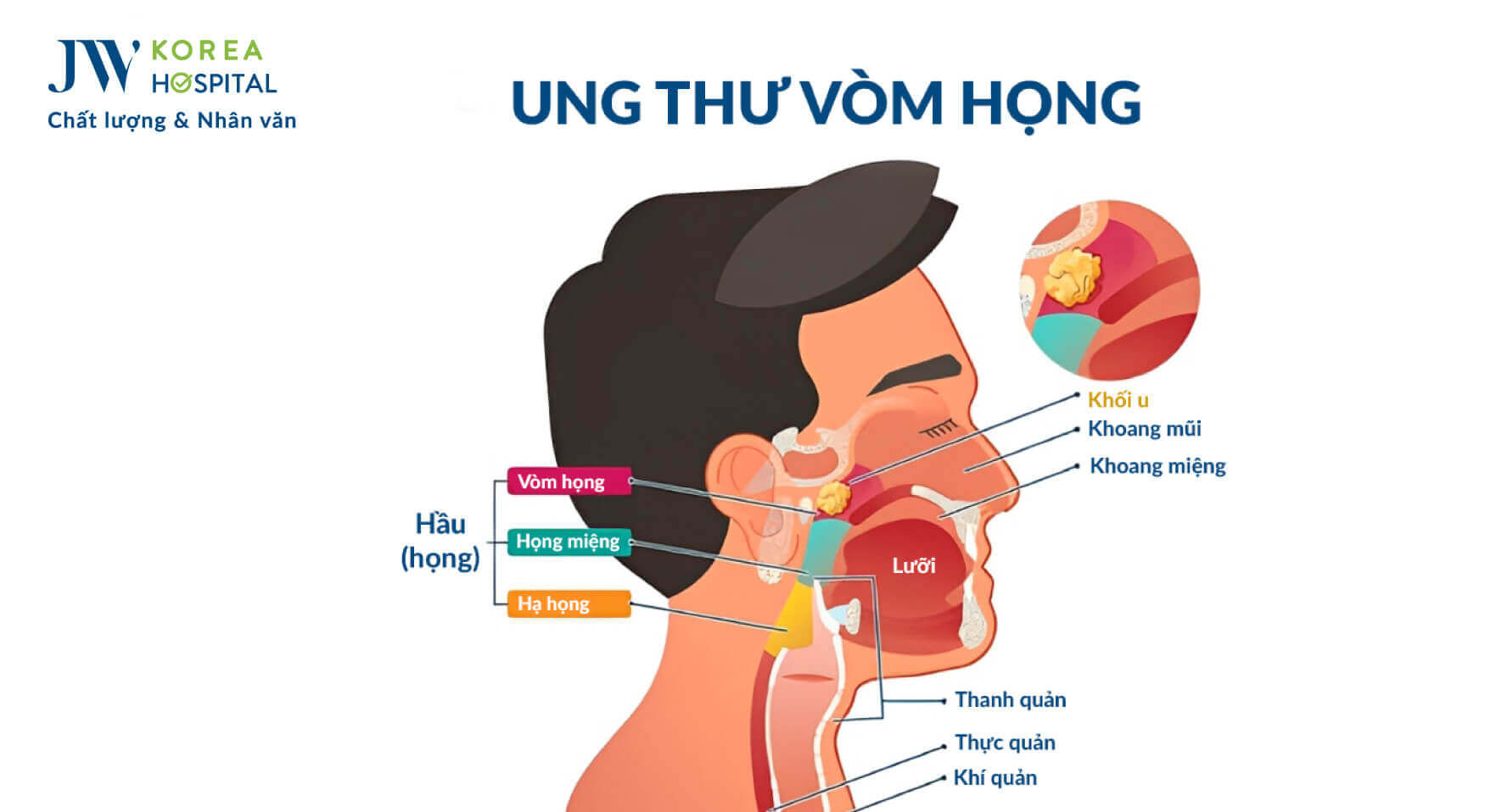 ung-thu-vom-hong
