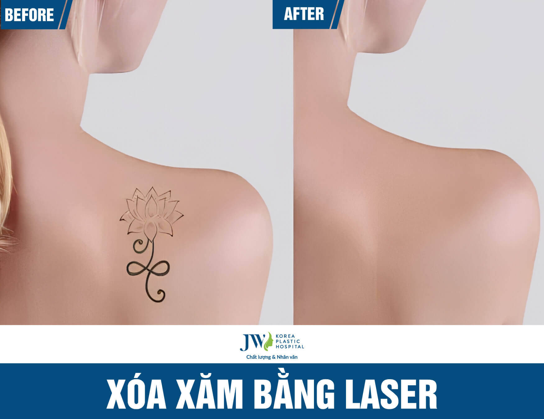 xoa-xam-laser