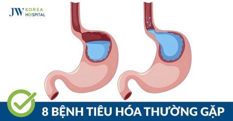 8 bệnh tiêu hóa: Dấu hiệu cảnh báo và cách phòng ngừa hiệu quả
