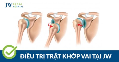 Trật Khớp Vai: Nguyên Nhân, Dấu Hiệu và Điều Trị Hiệu Quả Tại JW