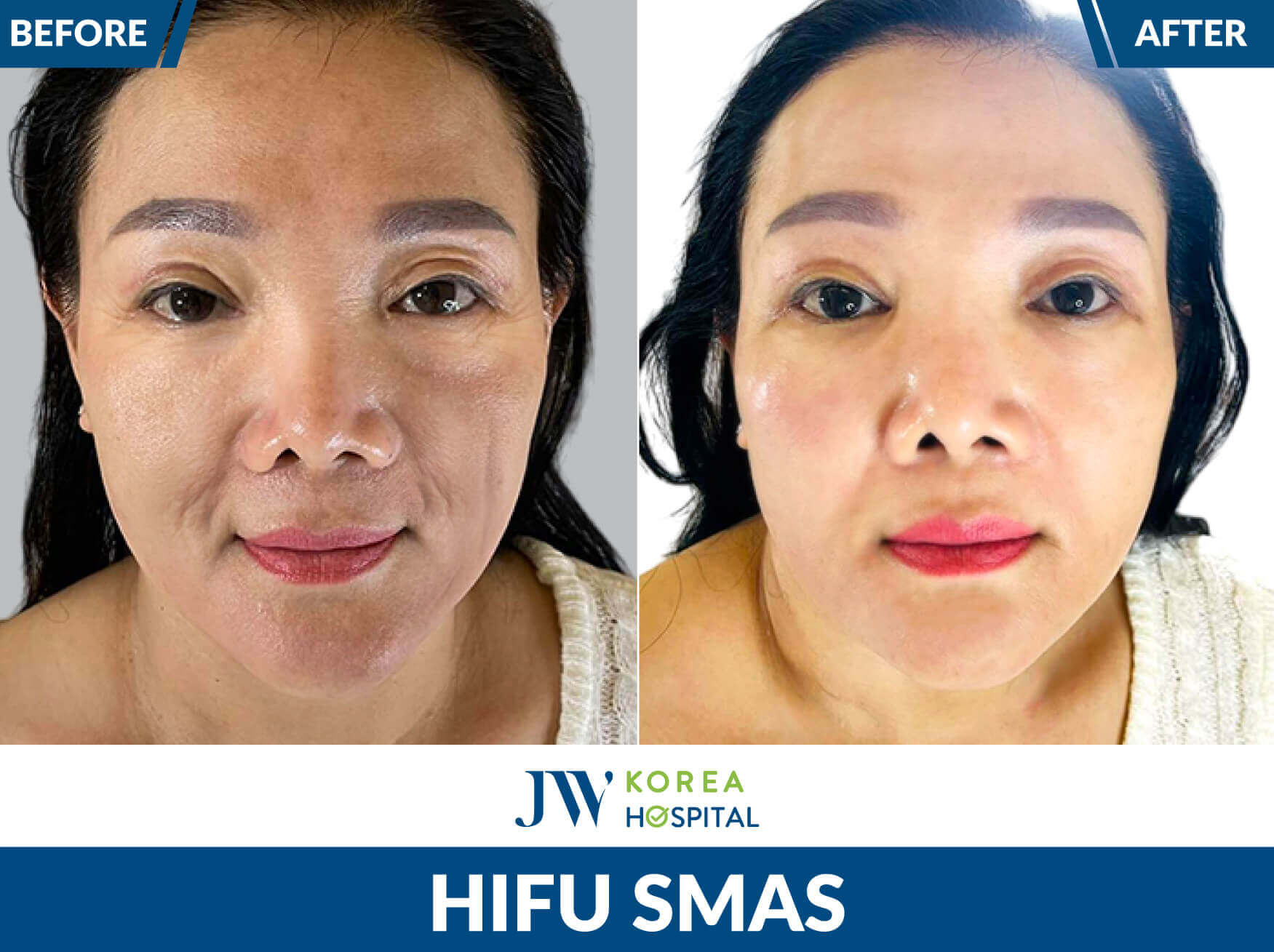 hifu-smas