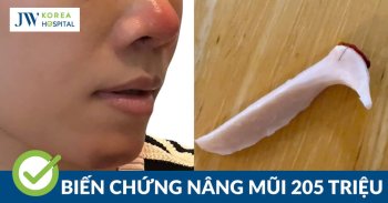 Chi 205 triệu đồng nâng mũi không dao kéo nhận cái kết tháo sụn, mũi hoại tử