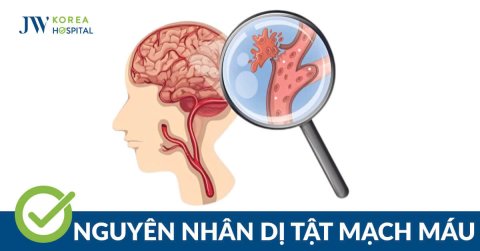 Dị tật mạch máu não: Nguyên nhân, dấu hiệu và cách điều trị