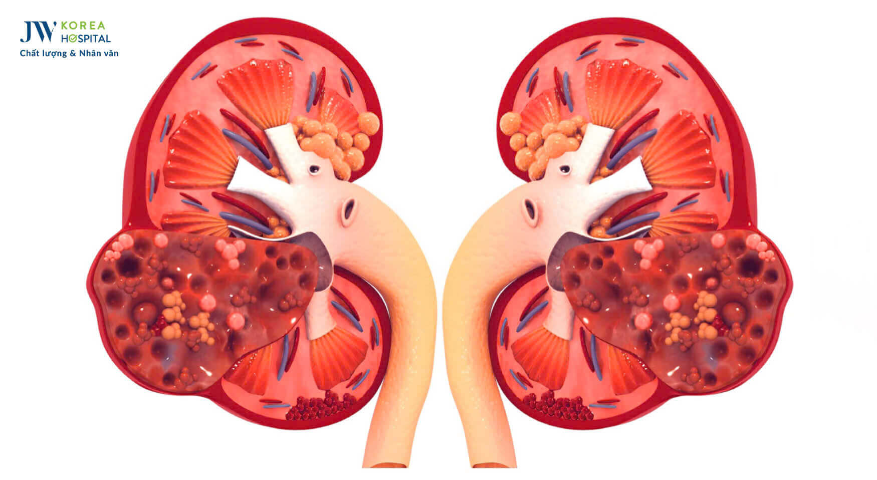 suy-than-la-gi-dau-hieu-benh-than