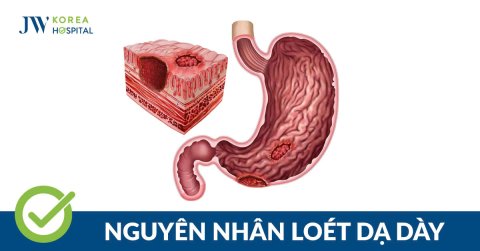 Bệnh viêm loét dạ dày: Nguyên nhân, triệu chứng và hướng điều trị