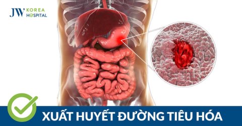 Xuất huyết tiêu hóa: Nhận biết sớm triệu chứng để tránh biến chứng nguy hiểm