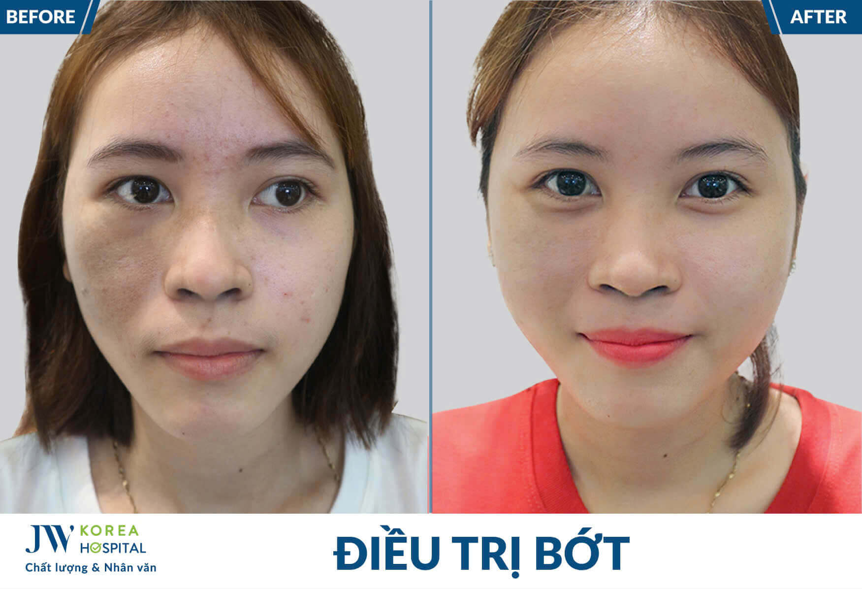 dieu-tri-bot