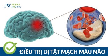 Dị tật mạch máu não là gì? Cách nhận biết tình trạng nguy hiểm
