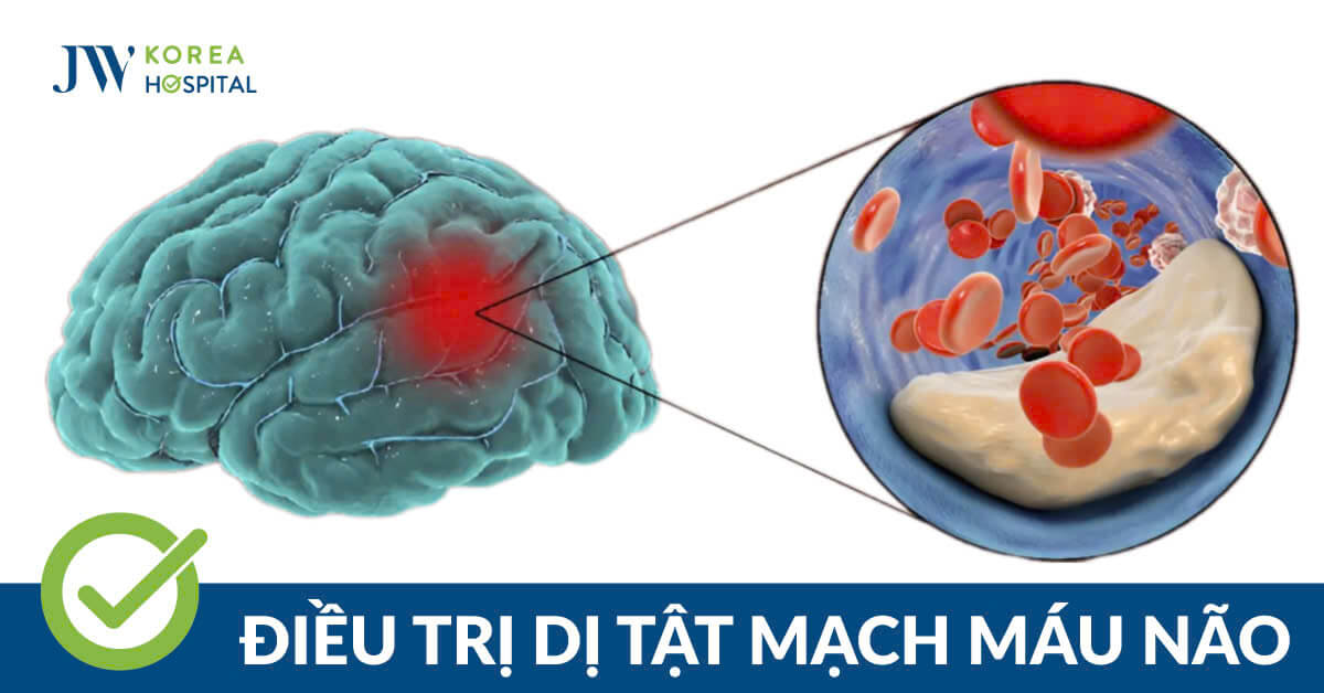 Dị tật mạch máu não là gì? Cách nhận biết tình trạng nguy hiểm