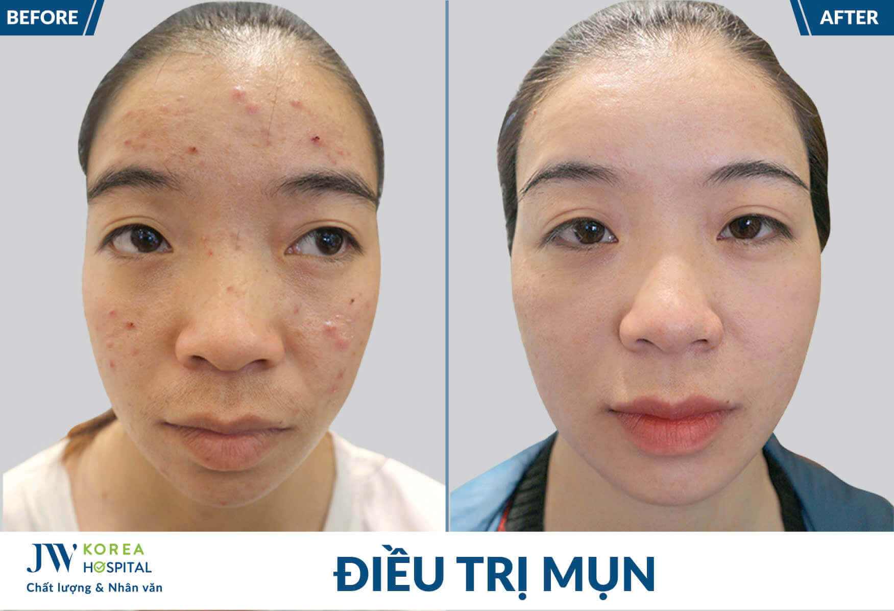 dieu-tri-mun