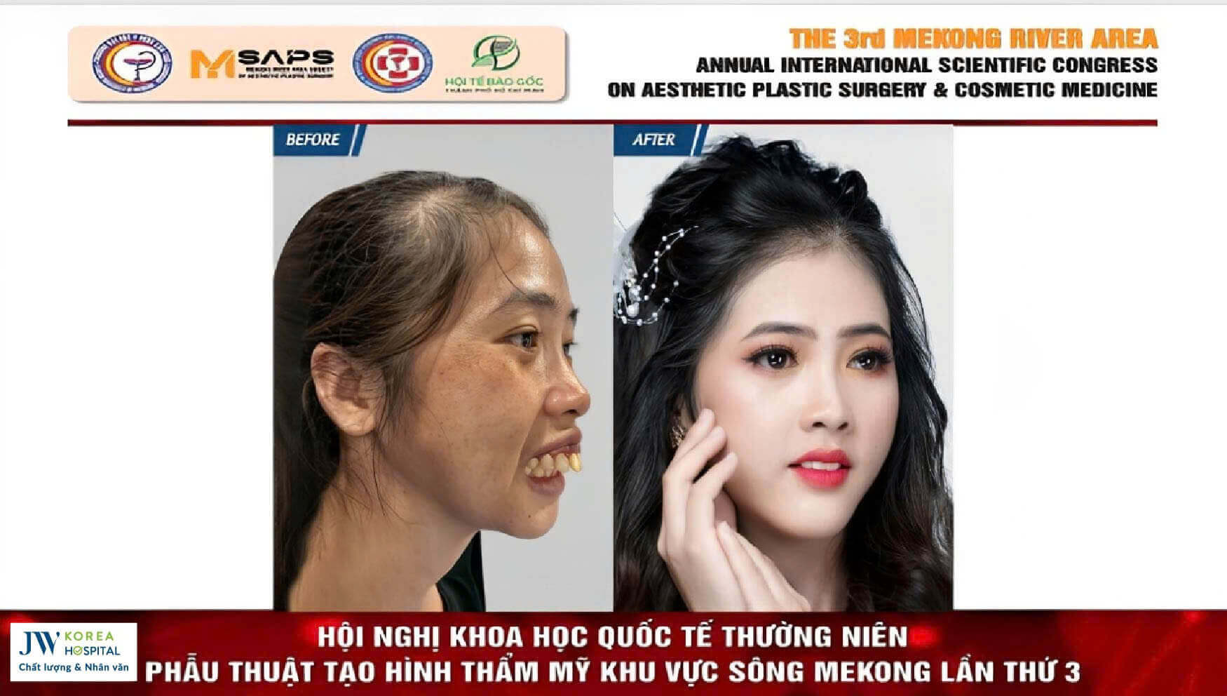 phau-thuat-ham-ho