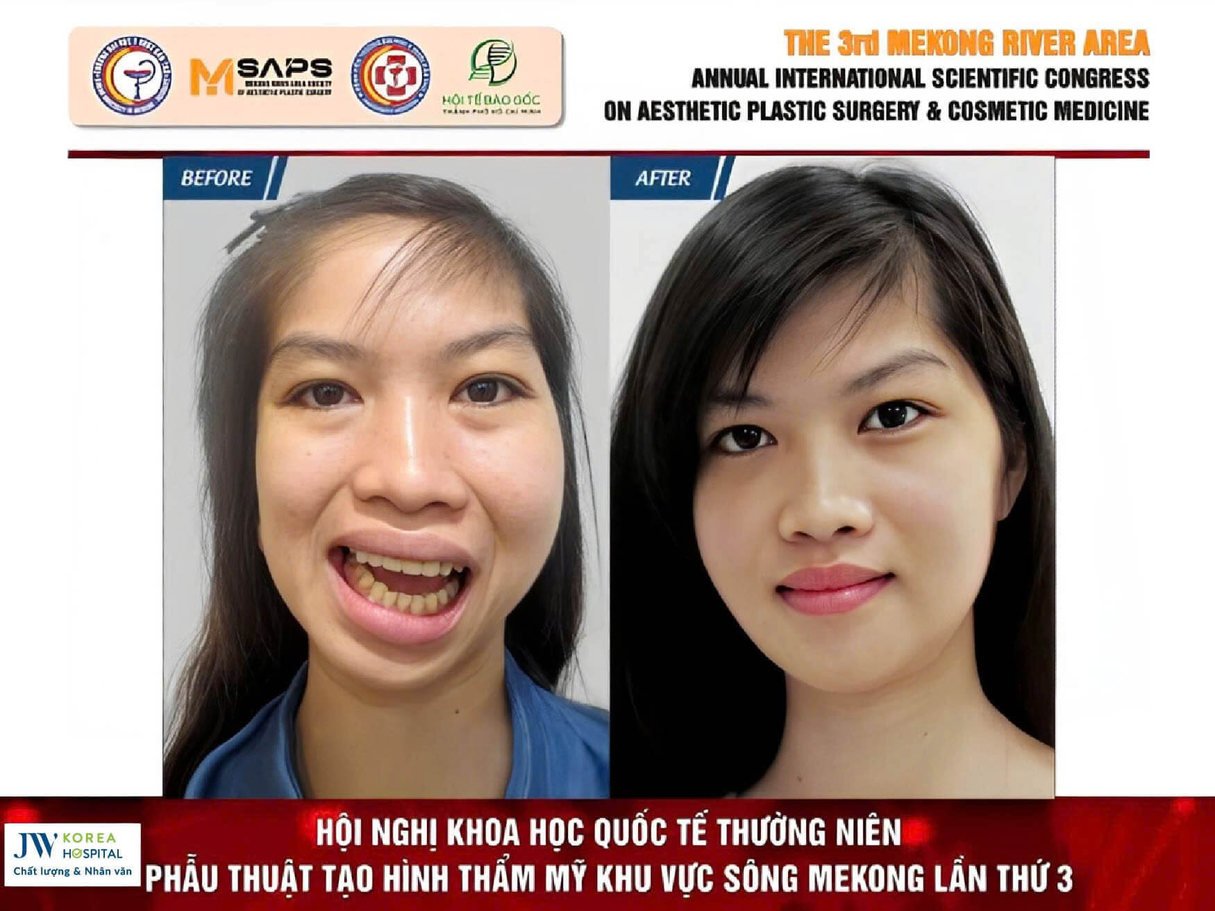 phau-thuat-ham-mom