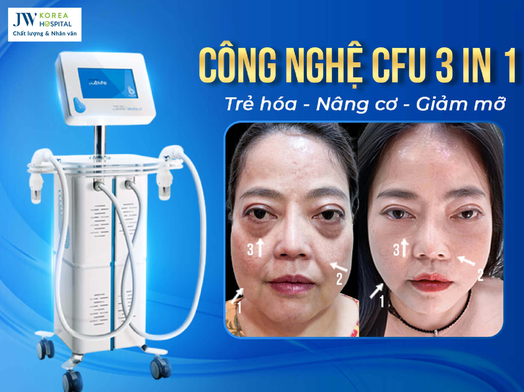 CFU 3 in 1 tre hoa nang co giam mo 