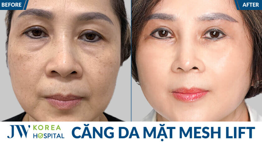 before after khach mesh lift 1