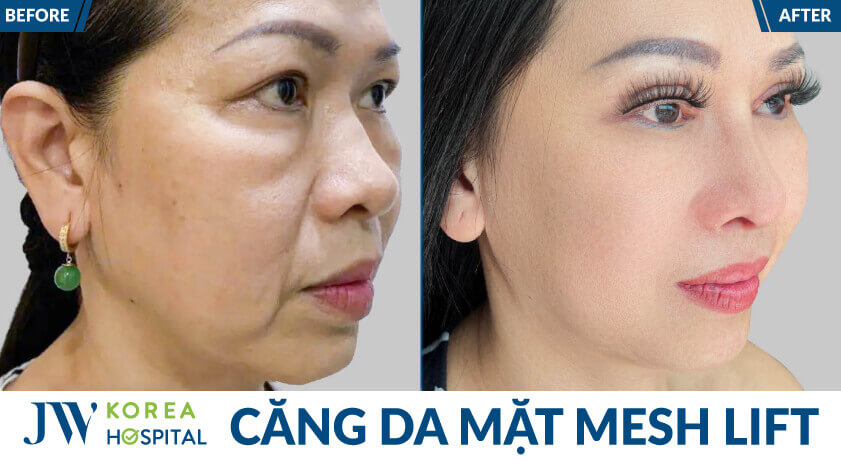 before after khach mesh lift 2