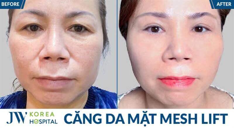 before after khach mesh lift 3