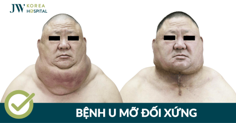 Hội chứng Madelung là gì? Nguyên nhân, triệu chứng và cách điều trị tại JW
