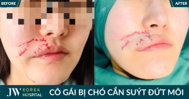 bi cho can suyt dut moi
