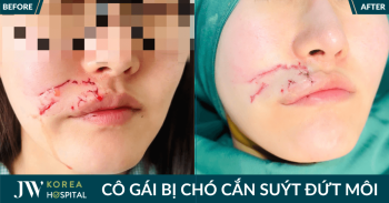 Bệnh viện JW vừa điều trị ngoạn mục cho Cô gái Hàn Quốc sau tai nạn bị chó cắn suýt đứt môi