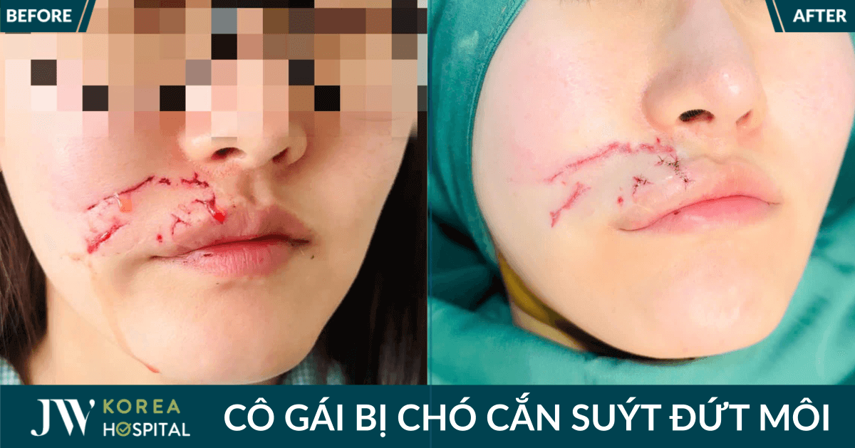 Bệnh viện JW vừa điều trị ngoạn mục cho Cô gái Hàn Quốc sau tai nạn bị chó cắn suýt đứt môi