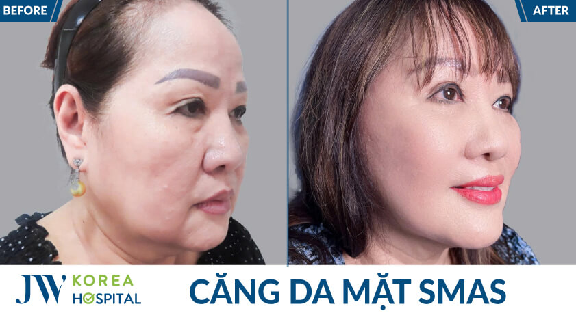 cang da mat goc nghieng
