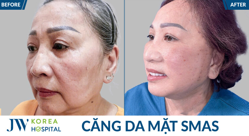 cang da mat goc ngieng