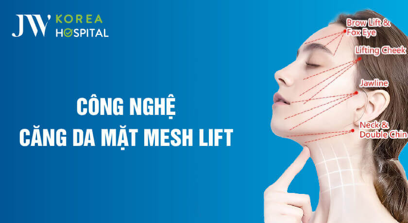 cong nghe cang da mesh lift