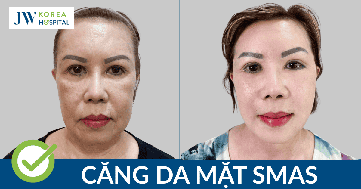 Căng Da Mặt SMAS tại Bệnh viện JW lấy lại 20 năm tuổi Xuân