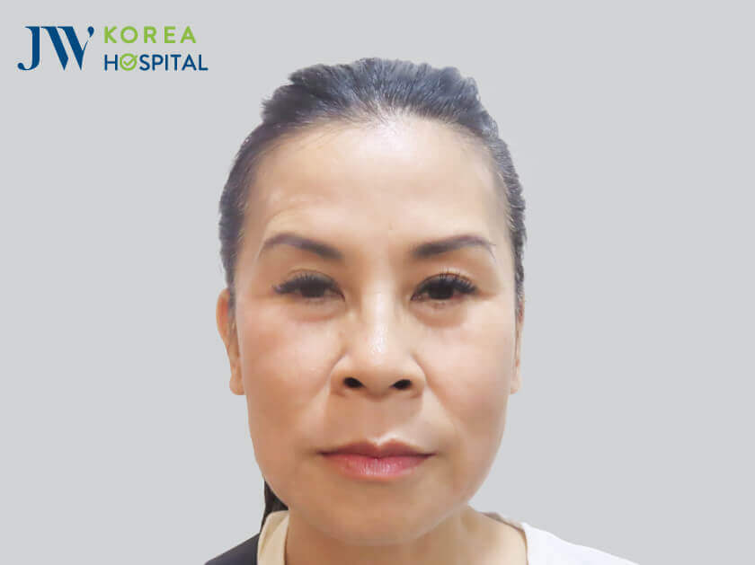 truoc khi cang chi mesh lift