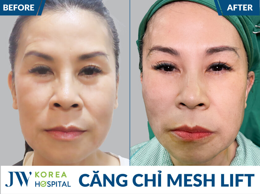 truoc sau mesh lift