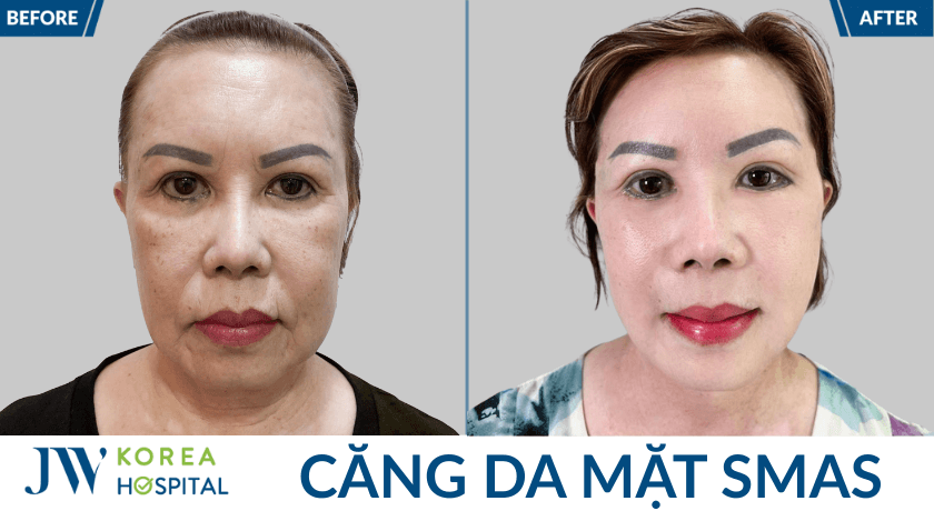 truoc va sau cang da mat 1