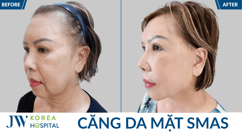 truoc va sau cang da mat goc nghieng