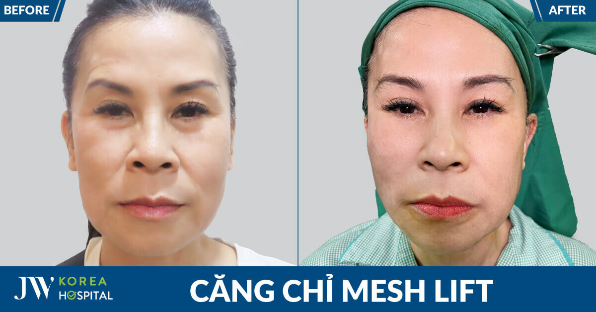 Căng chỉ Mesh Lift: Bí kíp trẻ 20 tuổi được 999+ Việt kiều lựa chọn
