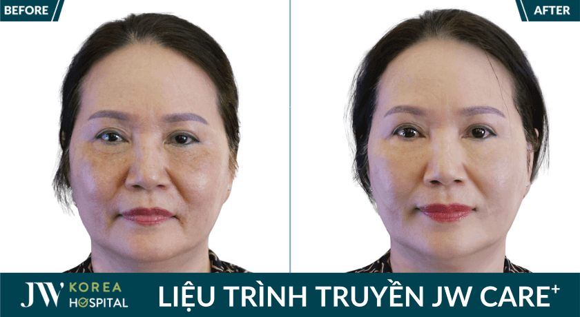 Before after khach 1
