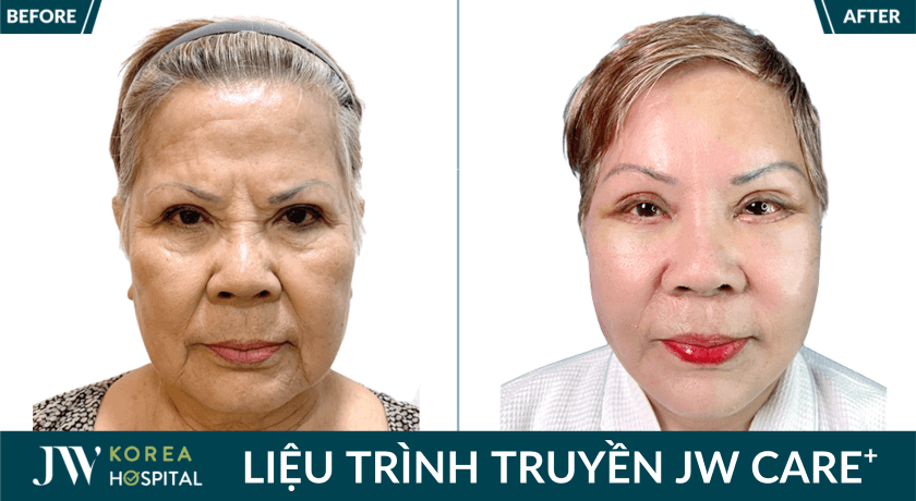 anh truoc sau khach hang 4