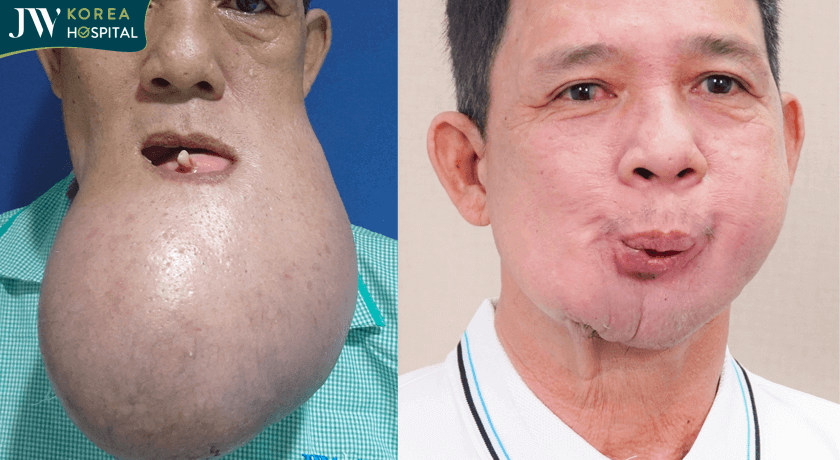 benh nhan mac khoi u khong lo