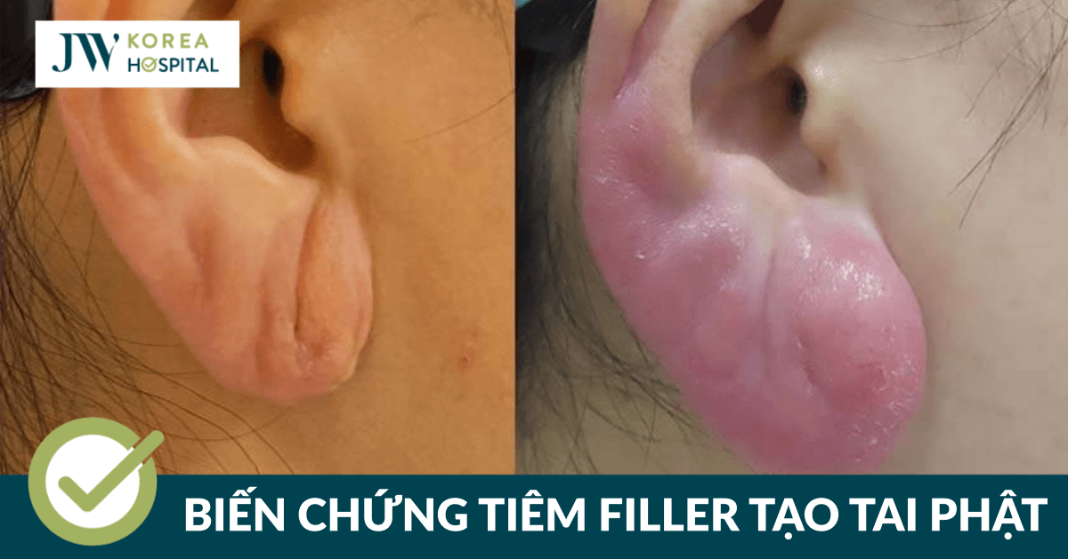 Tiêm filler tạo tai Phật, Việt kiều Mỹ khiến Bác sĩ Tú Dung giật mình với kết quả sau 1 năm thực hiện