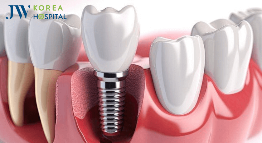 cam implant