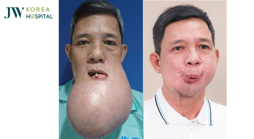 chu khanh khoi u