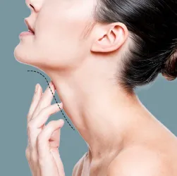 Hút mỡ nọng cằm