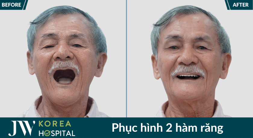 phuc hinh rang mat 2 ham
